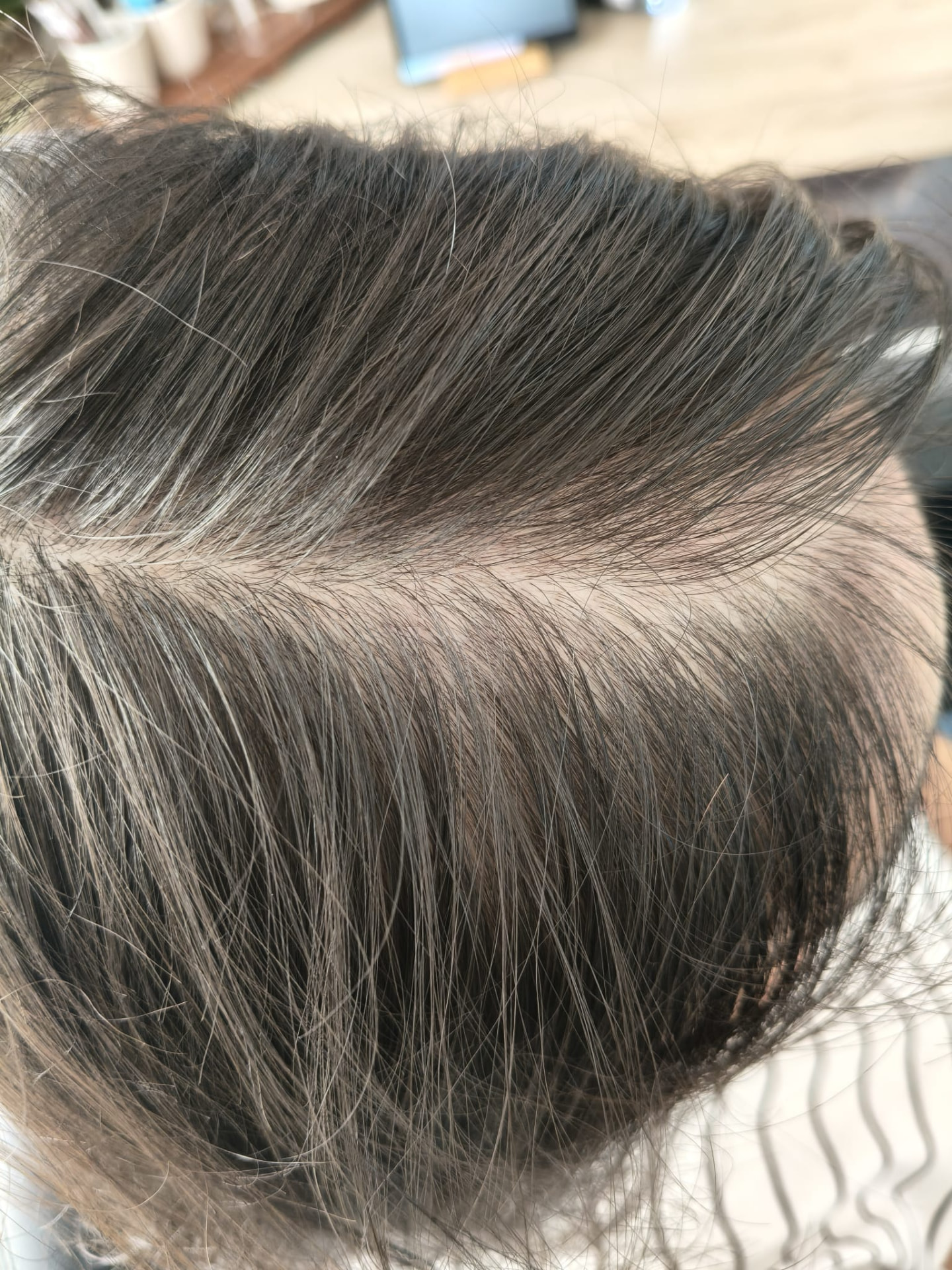 Terapia capilar — ganho de densidade — depois